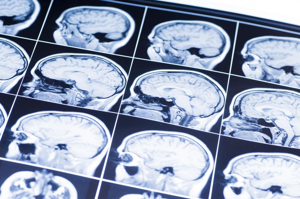 10 Symptoms of a Traumatic Brain Injury